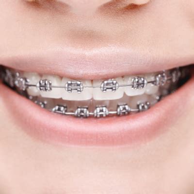 Straighten Your Smile with the Wave of a Wand: Magic Smile Teeth Braces Revealed